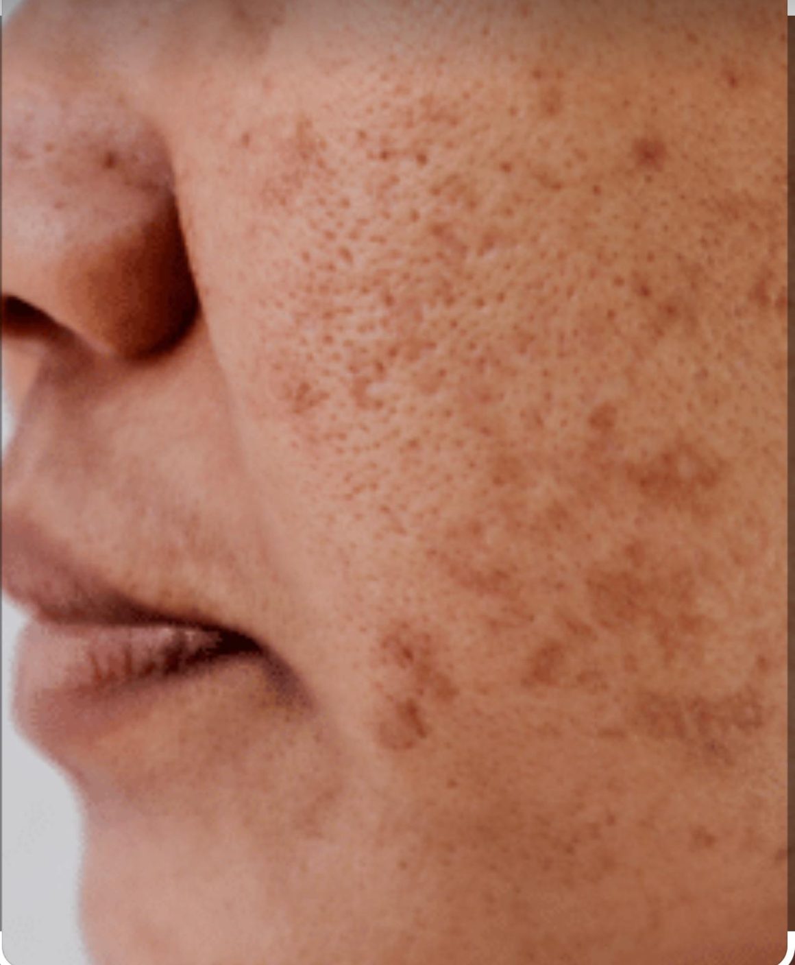 Pigmentation
