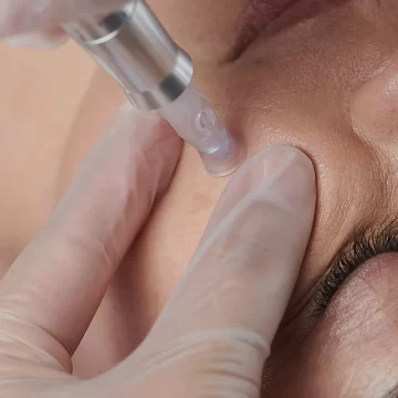 Microneedling